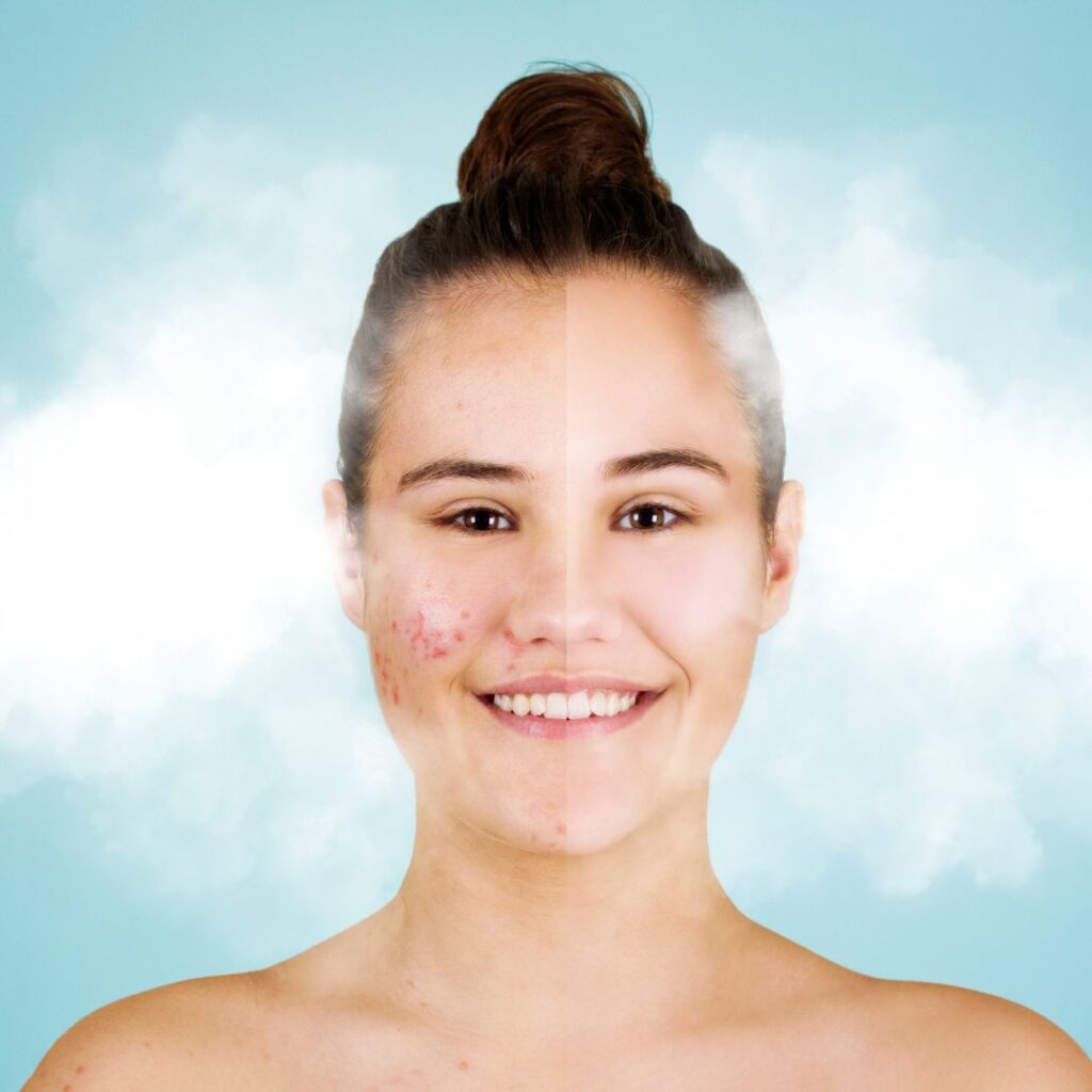 before and after Cryotherapy